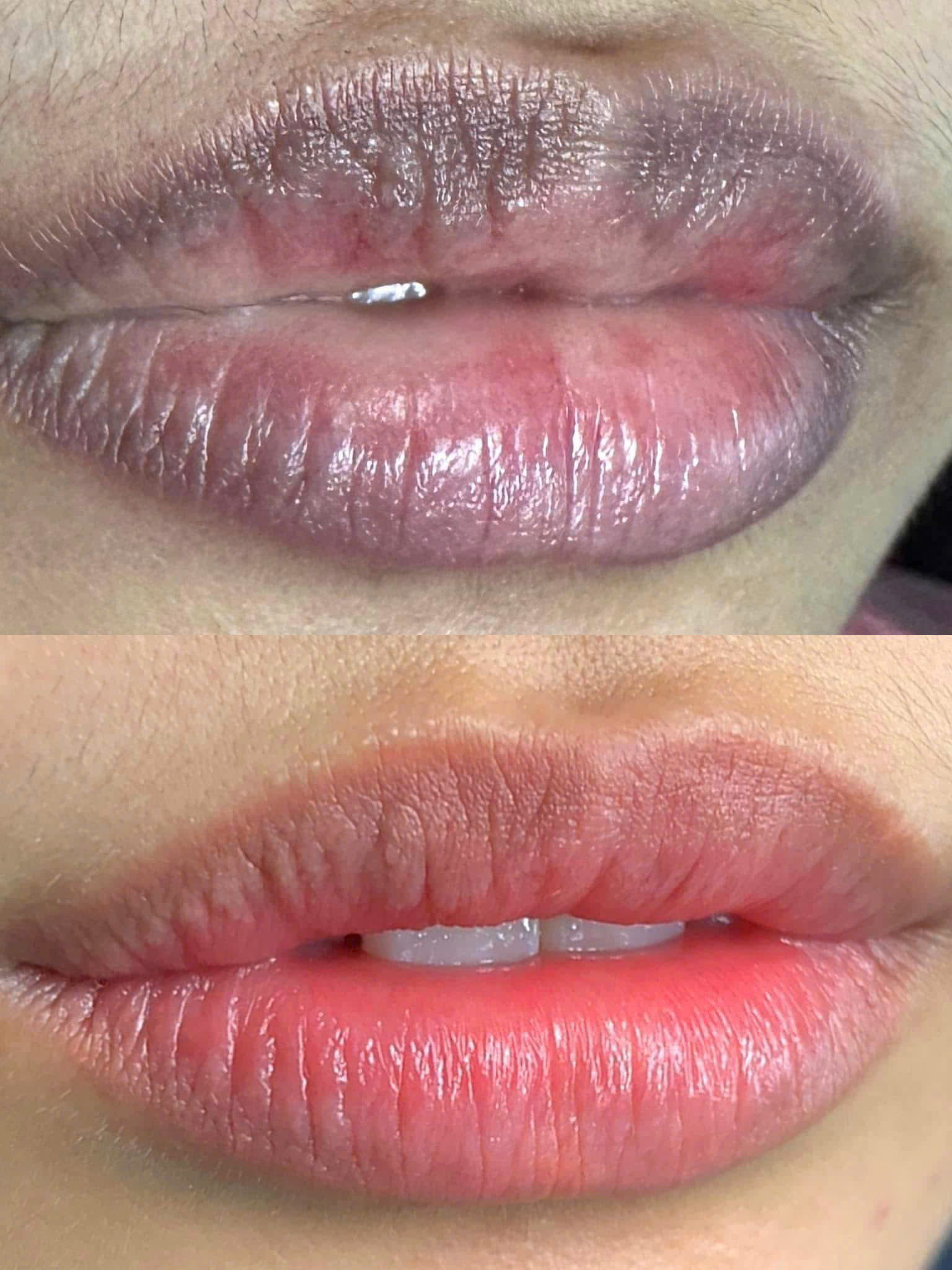 Trước - Sau khi phun môi